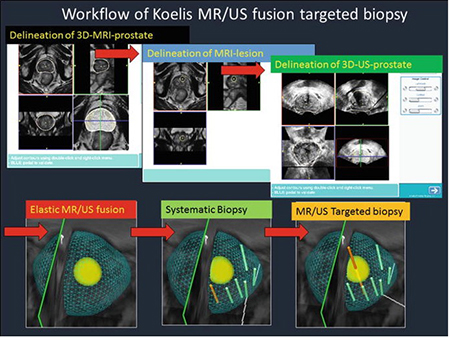 04 workflow of elastic fusion biopsy